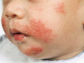 Cách nhận biết trẻ bị dị ứng sữa
