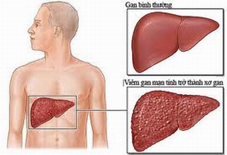 Bệnh viêm gan D lây truyền như thế nào?