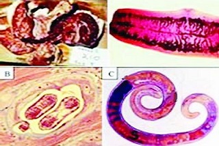 Biểu hiện khi mắc bệnh giun xoắn