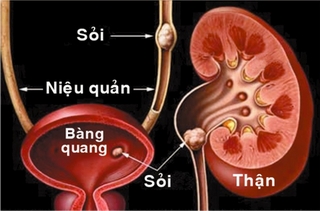 Lọc màng bụng trong điều trị bệnh suy thận mạn tính
