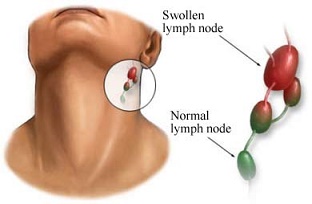 Việt Nam: Bệnh U lympho ác tính có chiều hướng gia tăng