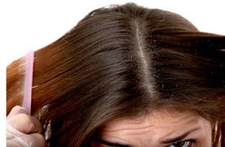 Nấm tóc: &quot;Thủ phạm&quot; gây hói đầu