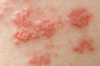 Bệnh lupus có thể &quot;phá&quot; nội tạng trong cơ thể