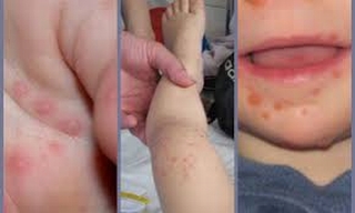 Ai dễ mắc bệnh tay chân miệng?