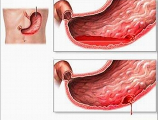 Xuất huyết tiêu hóa đe dọa tính mạng bệnh nhân