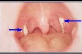 Bệnh bạch hầu nguy hiểm và dễ lây