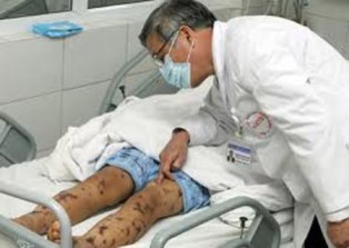 4 cách đơn giản phòng bệnh não mô cầu