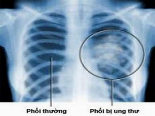 Ung thư phổi có thể nhầm với những bệnh nào ?