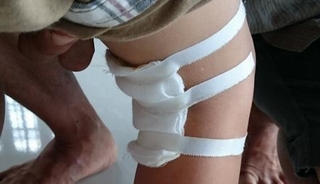 Bệnh nhi đau chân trái, bác sĩ lại mổ chân phải