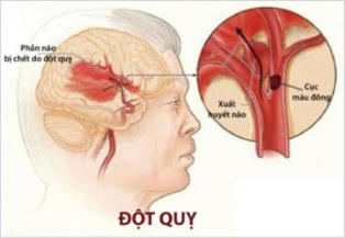 Dấu hiệu nhận biết người sắp đột quỵ
