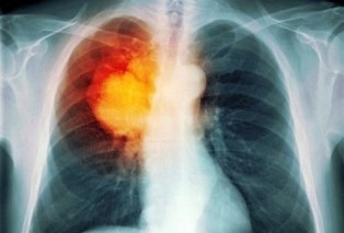 Một số bệnh dễ nhầm với lao phổi