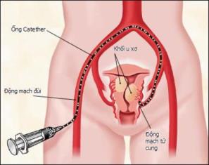 Dấu hiệu có thể bạn bị u xơ tử cung