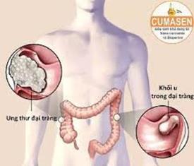 Ung thư đại tràng de dọa sức khỏe người Việt