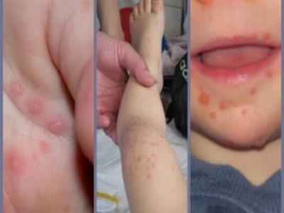 Cảnh giác bệnh tay chân miệng đầu năm học mới