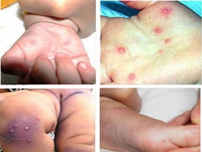 Dấu hiệu phát hiện sớm bệnh tay chân miệng ở trẻ