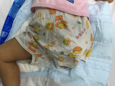 Bé gái 2 tuổi phải cắt cụt chân vì cha mẹ bất cẩn