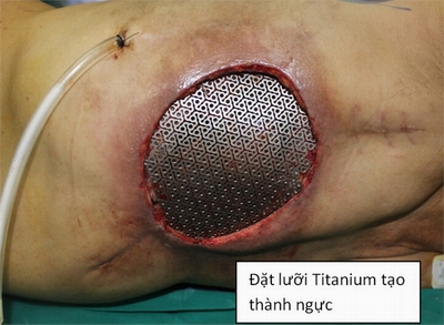 Cắt u, phẫu thuật thành công cho bệnh nhân nam ung thư vú