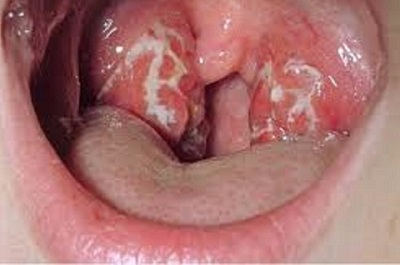 Nguy cơ lớn dịch bạch hầu có thể lây truyền sang Việt Nam