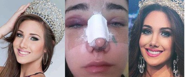 Tân Hoa hậu Quốc Tế vừa đăng quang đã lộ ảnh thẩm mỹ