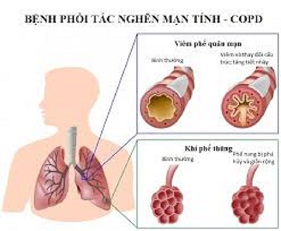 Khám, tư vấn miễn phí về bệnh phổi mãn tính