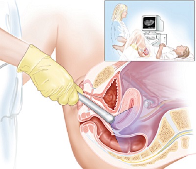 Dấu hiệu phát hiện sớm ung thư âm đạo