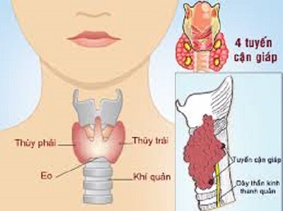 Yếu tố nguy cơ gây ung thư tuyến giáp
