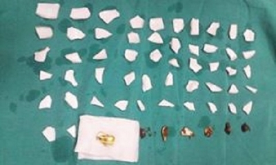 Mổ lấy 59 mảnh chén trong bụng và ruột bệnh nhân