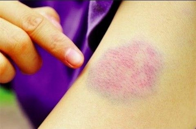Vết bầm tím da cảnh báo nhiều bệnh nguy hiểm