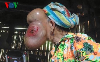 Ca bệnh kinh khủng chưa từng gặp tại Việt Nam