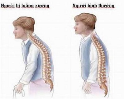 Khám, tư vấn chữa bệnh loãng xương miễn phí