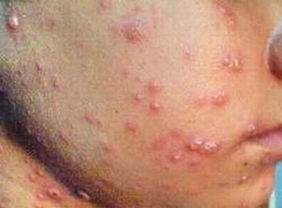 Bài thuốc hay trị trứng cá, mụn nhọt
