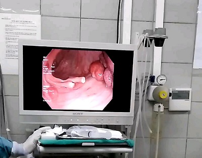 Cháu bé 10 tuổi có 30 polyp trong đường tiêu hóa