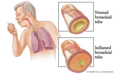 &quot;Thủ phạm&quot; gây viêm phế quản cấp
