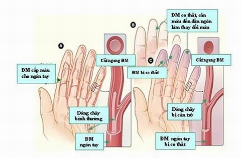 Nhiệt độ môi trường thấp khiến mạch máu ngoại biên co nhỏ làm bàn tay tái màu và lạnh ngắt.