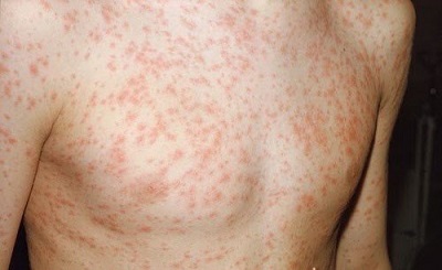 Bệnh sốt phát ban nguy hiểm như thế nào?