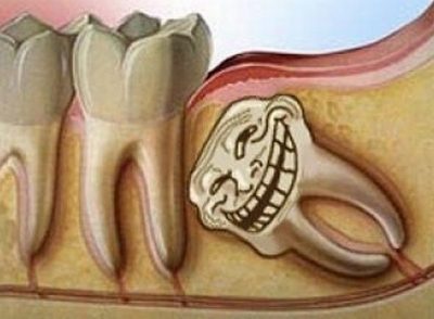 Thời điểm nào tốt nhất để nhổ răng khôn?