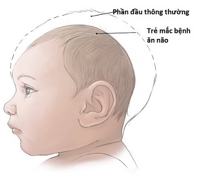 Virus &quot;ăn não&quot; nguy hiểm như thế nào?