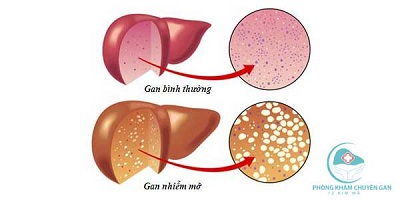 Gan nhiễm mỡ có thể dẫn đến ung thư gan