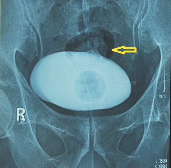 Chụp phim Cystography thấy thuốc ra ngoài bọng đái