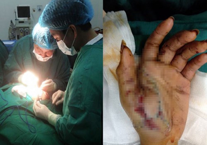 Đốt pháo tự chế, bé 12 tuổi trọng thương