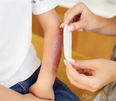 Những tai nạn thường gặp ở trẻ em vào những ngày Tết