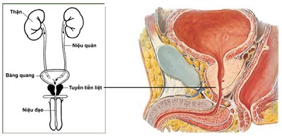 Dấu hiệu bạn mắc bệnh phì đại lành tính tuyến tiền liệt