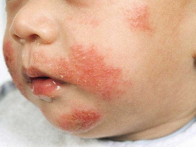 Những trẻ nào dễ bị dị ứng?