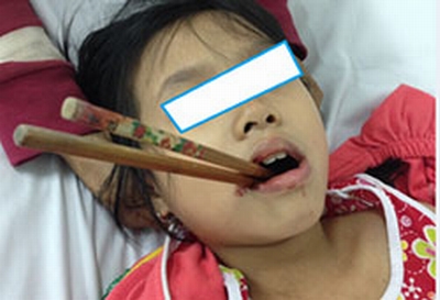 Bé gái 9 tuổi bị đôi đũa xuyên thẳng vào vòm họng
