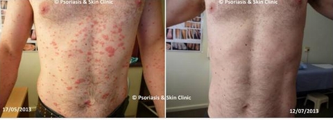 Điều trị bệnh vẩy nến thể giọt bằng phương pháp Dr Michaels trong 8 tuần