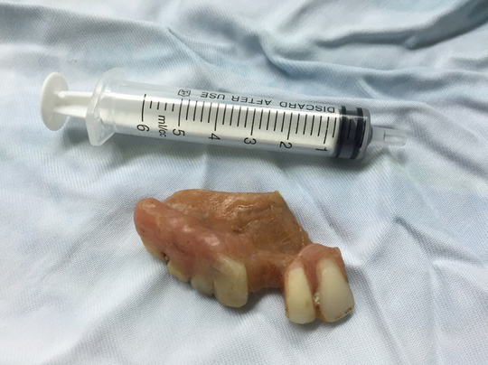Nhập viện vì ăn bún nuốt cả hàm răng giả