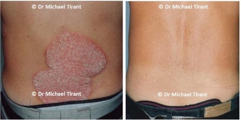 Điều trị bệnh vảy nến bằng phương pháp Dr Michaels thảo dược trong 8 tuần