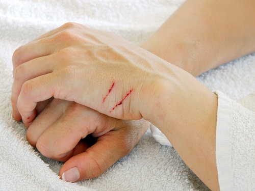 Tử vong vì một vết xước nhỏ