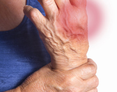 Nguy cơ tim mạch ở bệnh nhân viêm khớp điều trị thuốc kháng viêm