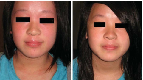 Điều trị viêm da dị ứng bằng phương pháp Dr Michaels thảo dược